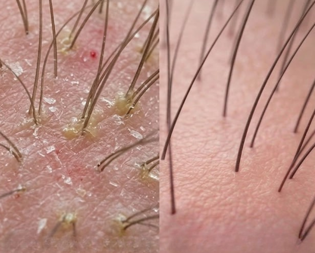 Scalp Scrubbing: Why It's the Step You're Skipping